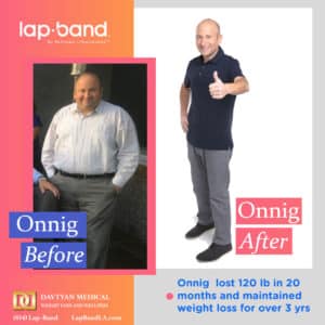 Onnig Lap-Band weight loss surgery before and after