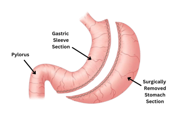 Gastric Sleeve Infographic 