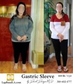 Bariatric Surgery - Before & After Weight Loss Photo - Lap-Band® Patient ( Gastric Band Sleeve Bypass Balloon)