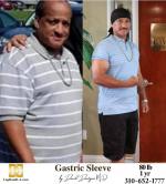 Bariatric Surgery - Before & After Weight Loss Photo - Lap-Band® Patient ( Gastric Band Sleeve Bypass Balloon)