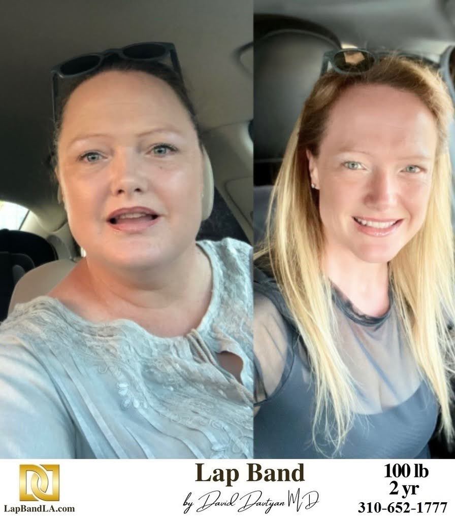 Bariatric Surgery - Before & After Weight Loss Photo - Lap-Band® Patient