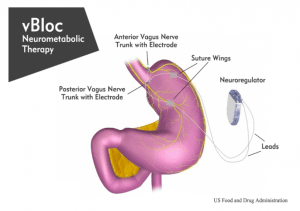 vBloc Neurometabolic therapy