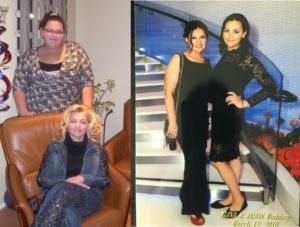 Best Weight Loss Surgery Before And After 8 Years Lap Band Mother And Daughter