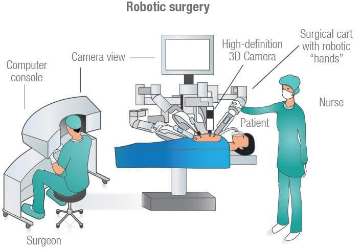 tortura Persuasivo En todo el mundo Robotic Approach Falls Short For Gastric Sleeve | The Weight Loss Surgery  Center Of Los Angeles