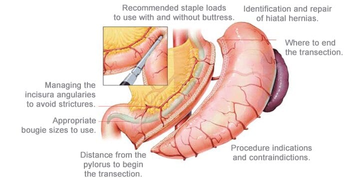 Gastric Sleeve Anatomy At The Weight Loss Surgery Center Of Los Angeles