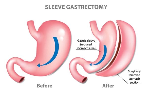 Sleeve Gastrectomy - stomach beofore and after surgery