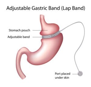 Adjustable Gastric Band (Lap Band)