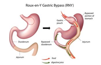 Lap Band vs Gastric Bypass Surgery
