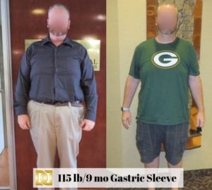 Gastric Sleeve Weight Loss Surgery before and after comparison 2