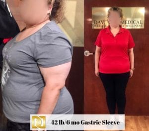 Gastric Sleeve Weight Loss Surgery before and after comparison 3