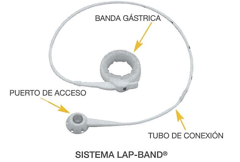 Banda Gastrica Lap-Band 2