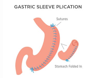 Gastric Sleeve Plication Surgery