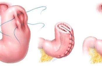 Gastric plication surgery stages