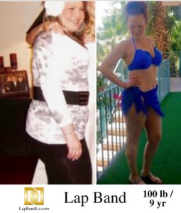 weight loss surgery before and after