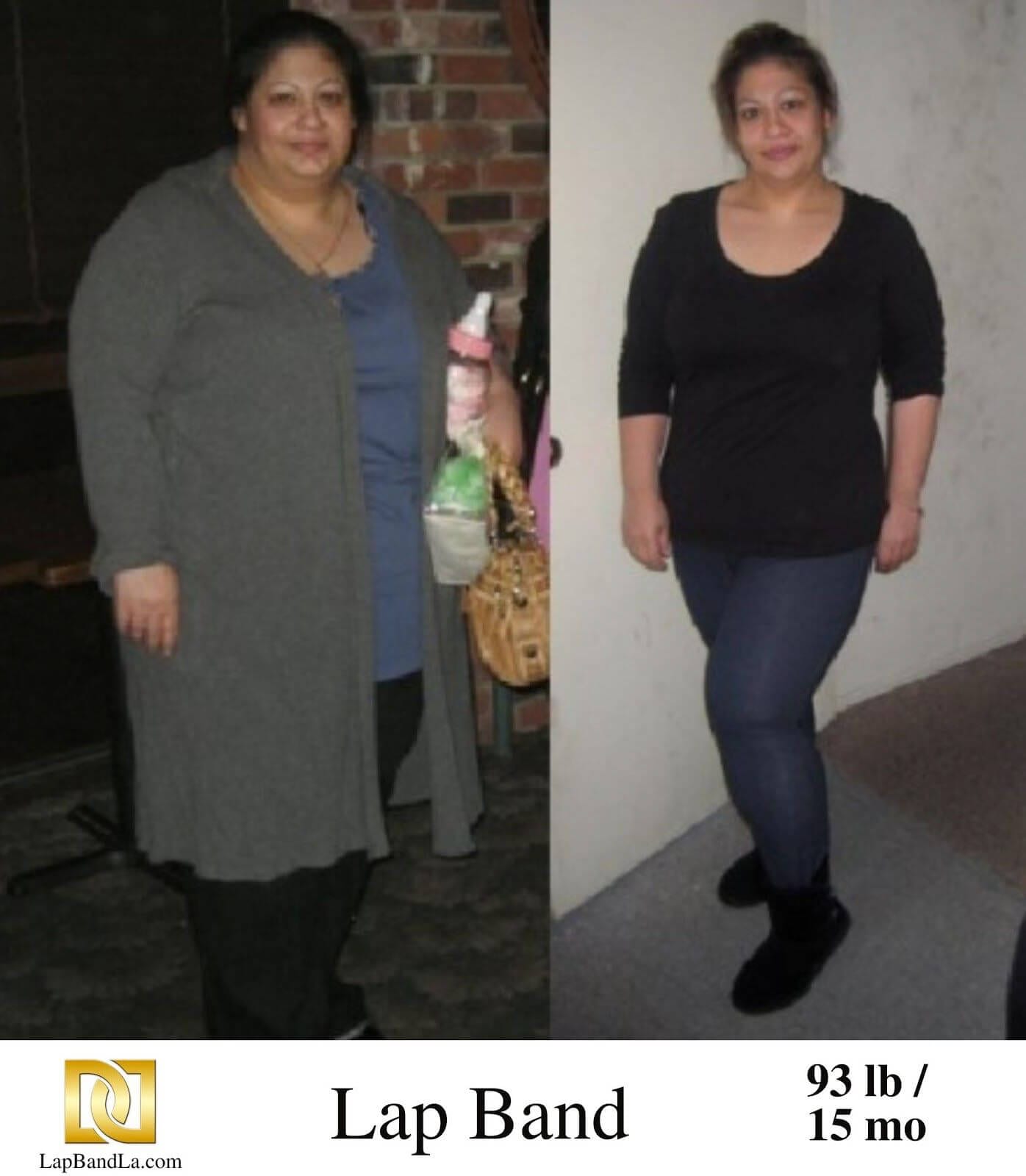 &Amp;Lt;H1 Class=&Amp;Quot;Hide_09&Amp;Quot;&Amp;Gt;Bariatric Surgery &Amp;Lt;Br&Amp;Gt;Before And After - Anita S.&Amp;Lt;/H1&Amp;Gt; | Success_Storie | The Weight Loss Surgery Center Of Los Angeles | Dr. David Davtyan