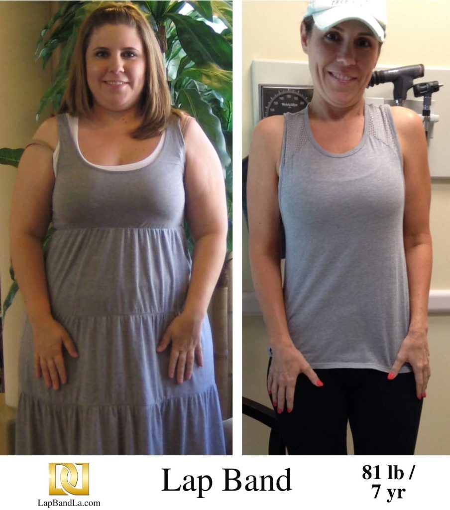 A lap band female patient who has lost 81 lb before and 7 years after surgery.