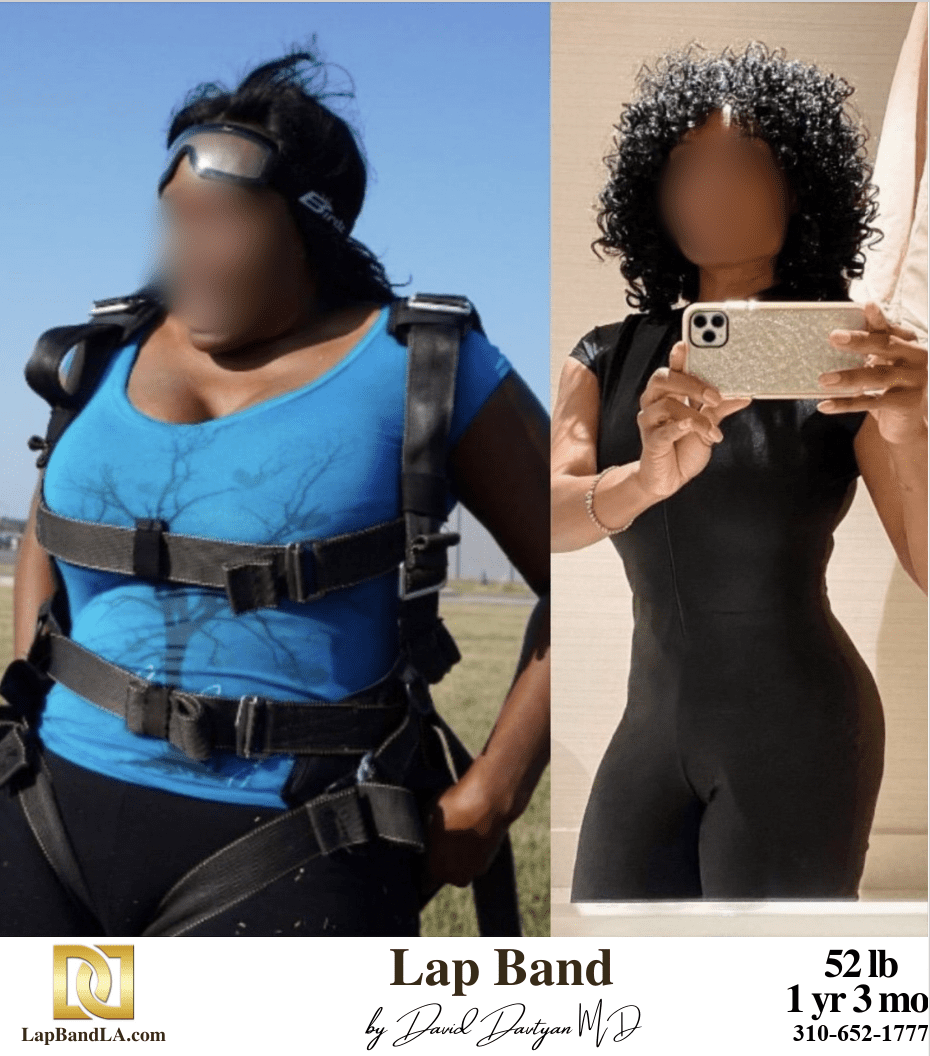 Lap Band Surgery Before & After Photo by Dr. Davtyan Bariatric Surgeon