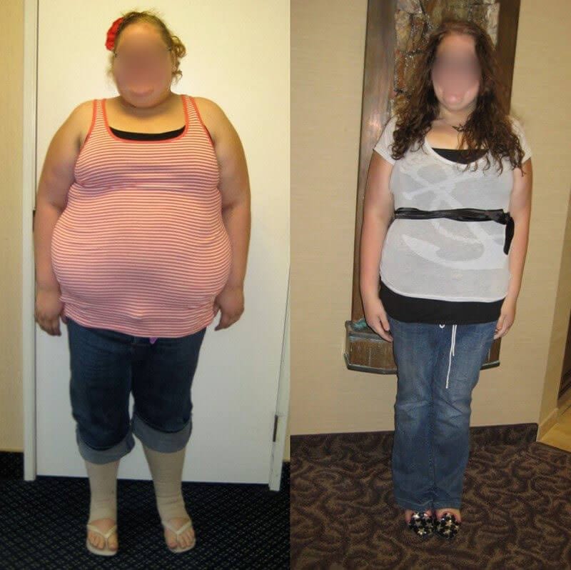 Lap Band Surgery Before and After in Los Angeles, California