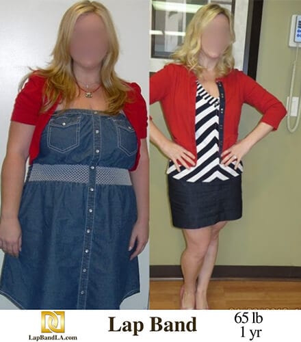 Lap Band Surgery Before and After in Los Angeles, California