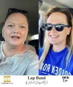 Dr. Davtyan's Patients Transformation After Bariatric Surgery | Before & After Photo's