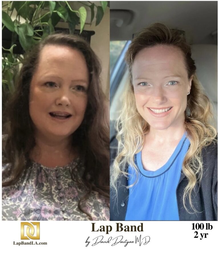 Weight Loss Surgery with Lap Band before and after comparison