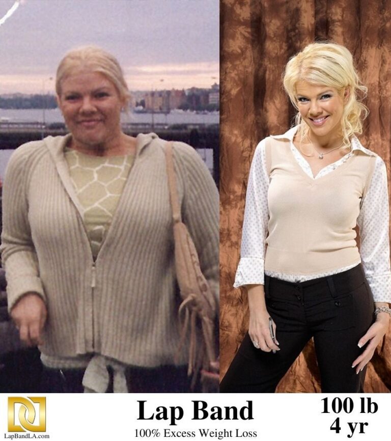 Weight Loss Surgery with Lap Band before and after comparison by Dr David Davtyan in Los Angeles