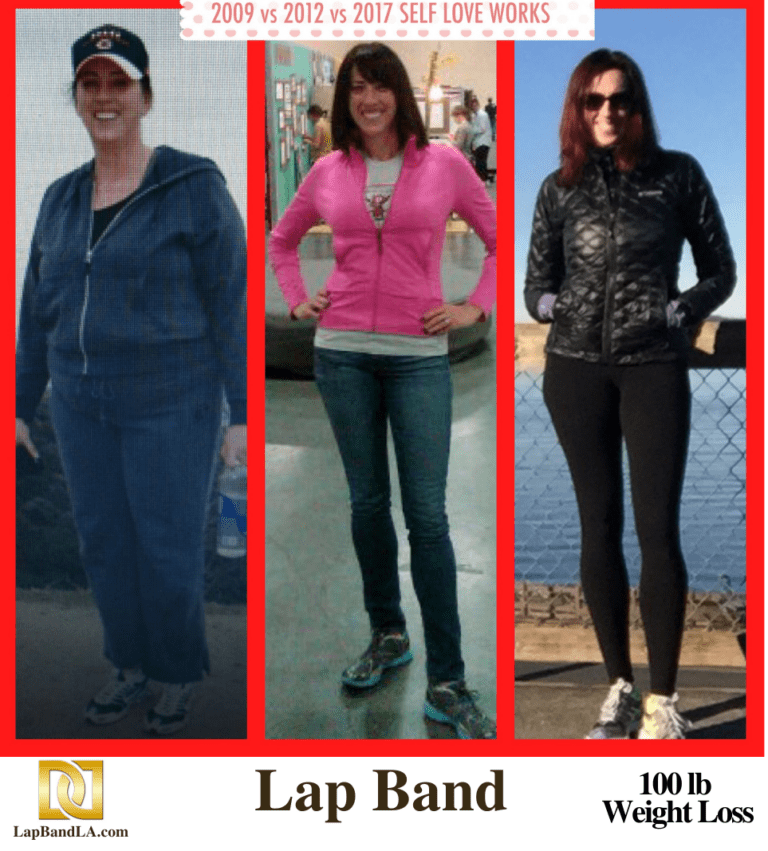 Weight Loss Surgery with Lap Band before and after comparison