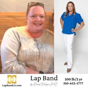 Bariatric Surgery Frequently Asked Questions Lap Band Before and After Comparison 2
