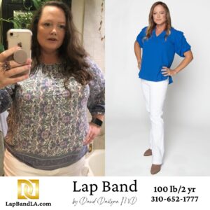 Lap band weight loss surgery before and after FIona