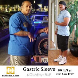 Gastric Sleeve Weight Loss Surgery before and after comparison of Antonio