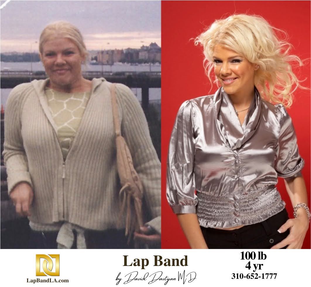 Female patient before and after Lap Band Weight Loss Surgery