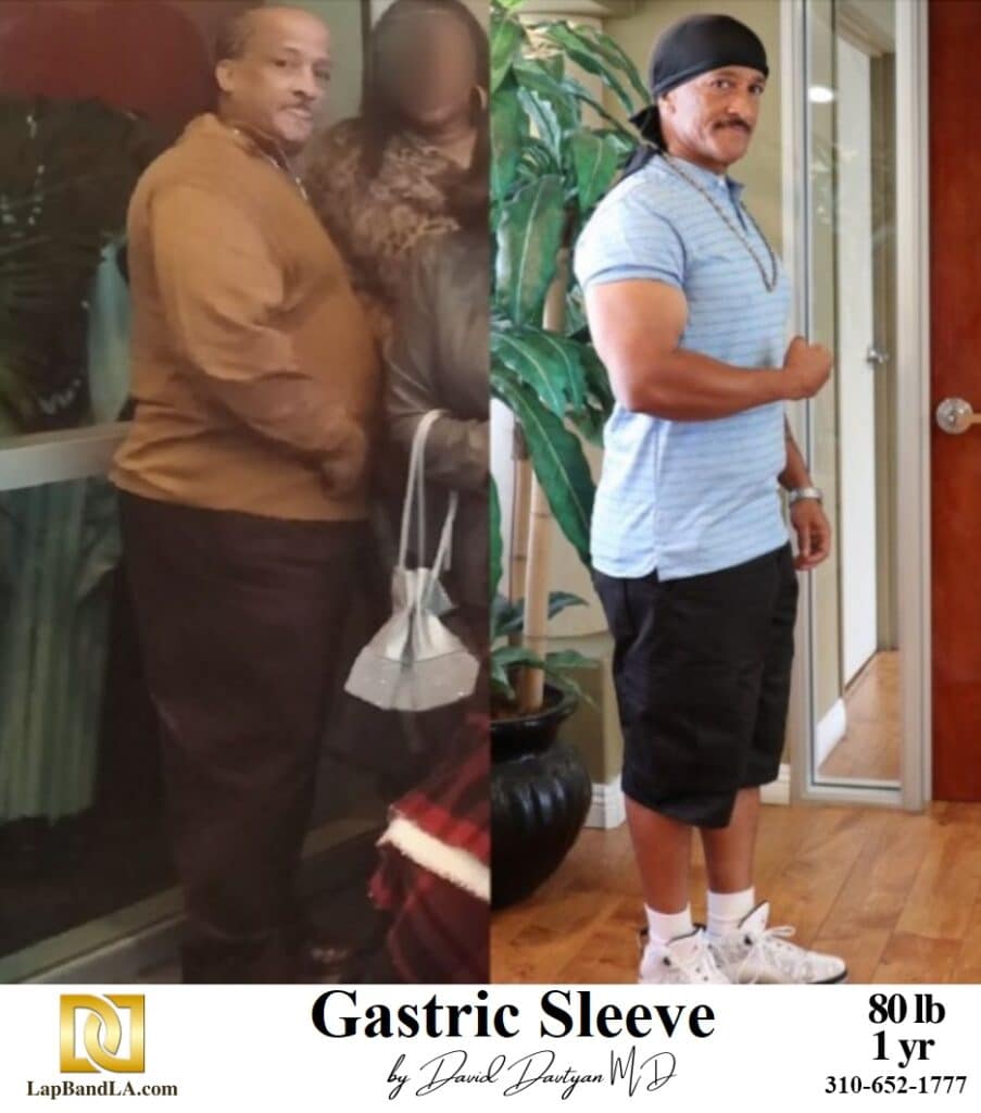 Weight Loss Surgery Before and After Gallery | The Weight Loss Surgery ...
