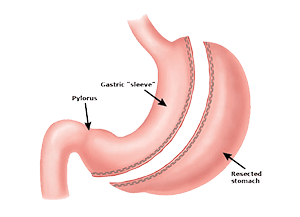 Gastric Sleeve - The Weight Loss Surgery Center Of Los Angeles
