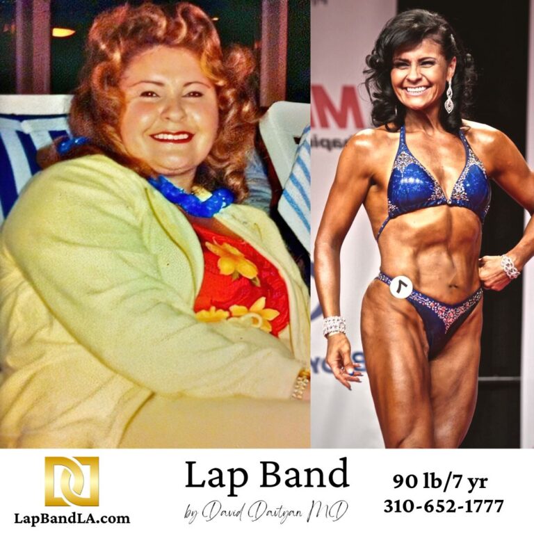Lap band weight loss surgery female patient before and after