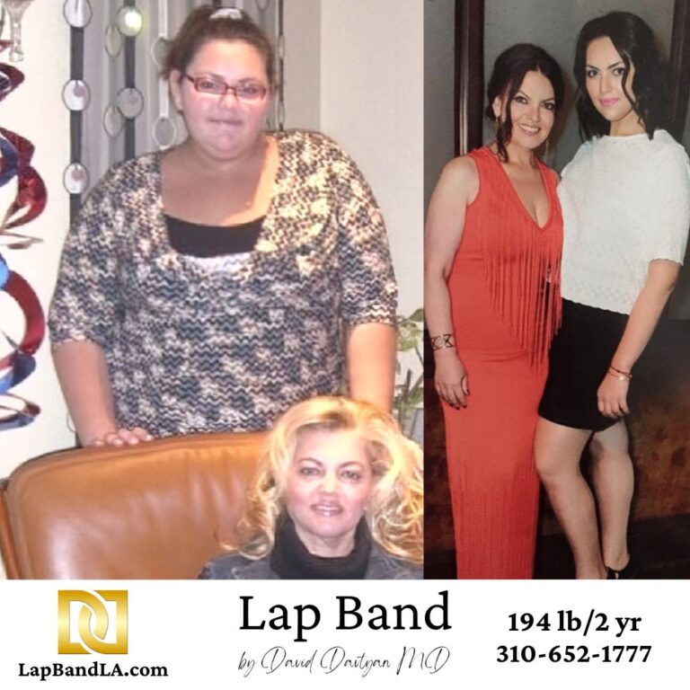 Dr Davtyan's Weight Female Loss Program Patient Before and After The Process