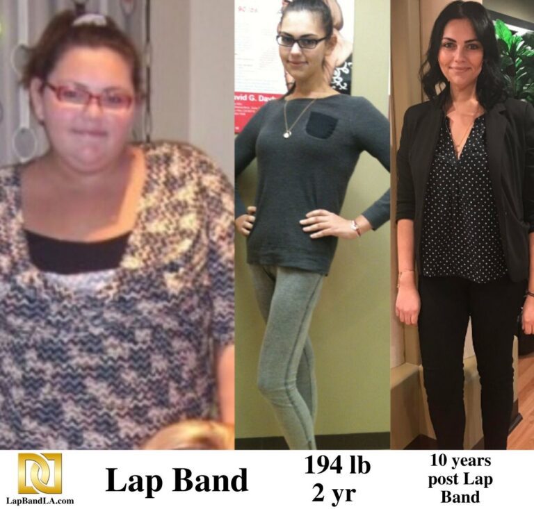 Dr Davtyan's female patient before and 2 years after lap band weight loss surgery