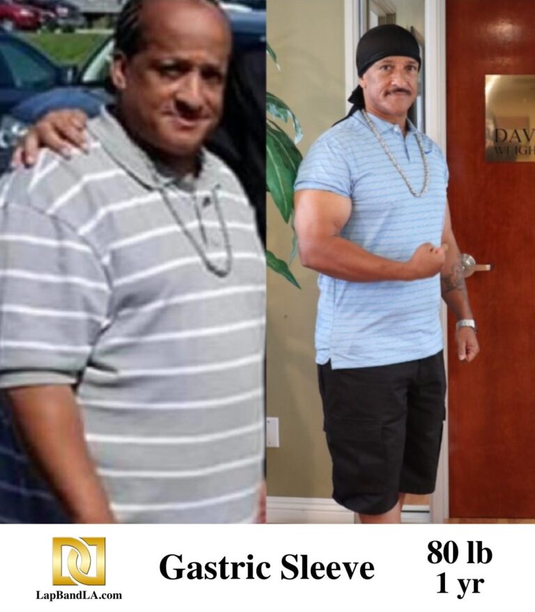 Dr Davtyan's male patient before and 1 year after lap band weight loss surgery