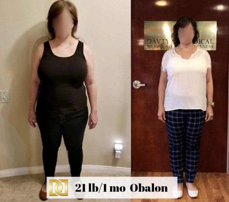 Dr Davtyan's Obalon Balloon Weight Loss Patient Before and After comparison