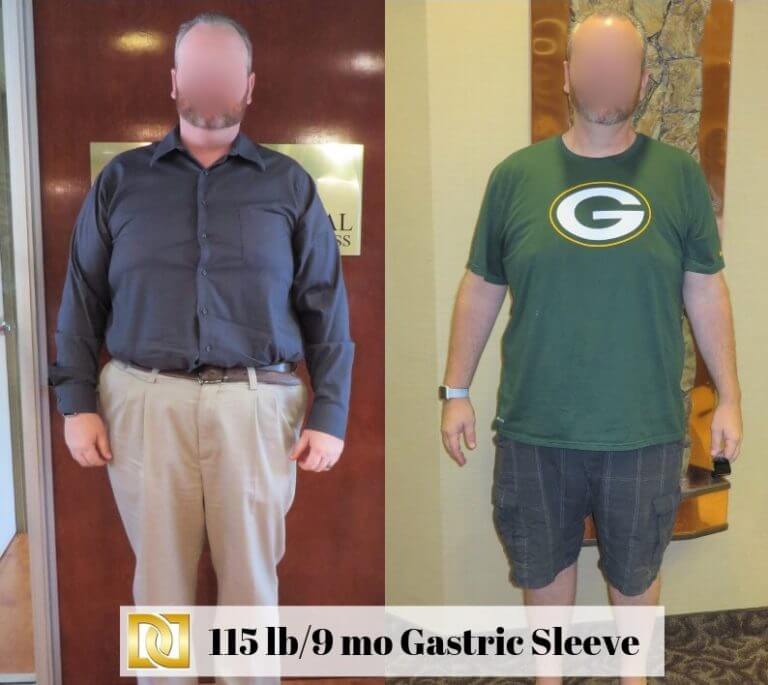 Dr Davtyan's Male Patient Before and After Gastric Sleeve Weight Loss Surgery