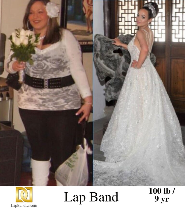 Dr Davtyan's female patient before and 9 years after lap band weight loss surgery
