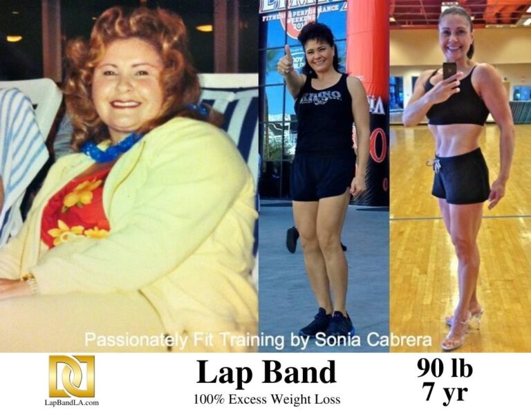 Sonia Cabrera before and 7 years after lap band surgery
