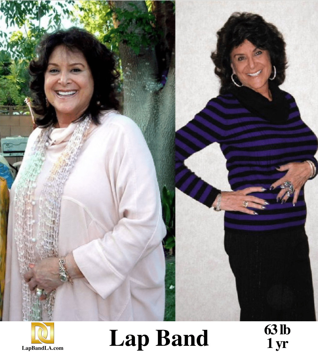 Dr Davtyan's female patient before and 1 year after lap band weight loss surgery