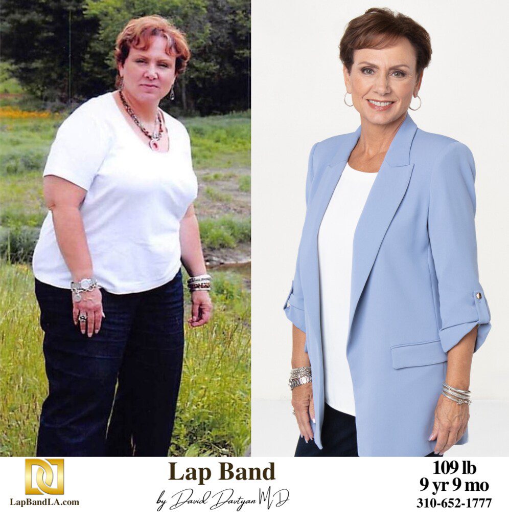 Dr Davtyan's Female Patient Before and After Bariatric Weight Loss Surgery