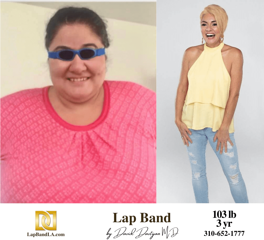 Dr Davtyan's female patient before and 3 years after lap band weight loss surgery