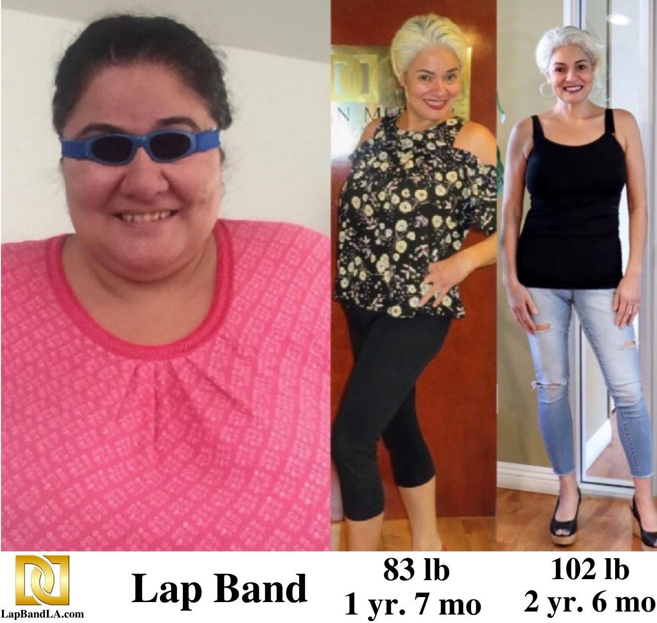 Dr Davtyan's female patient before and after lap band weight loss surgery