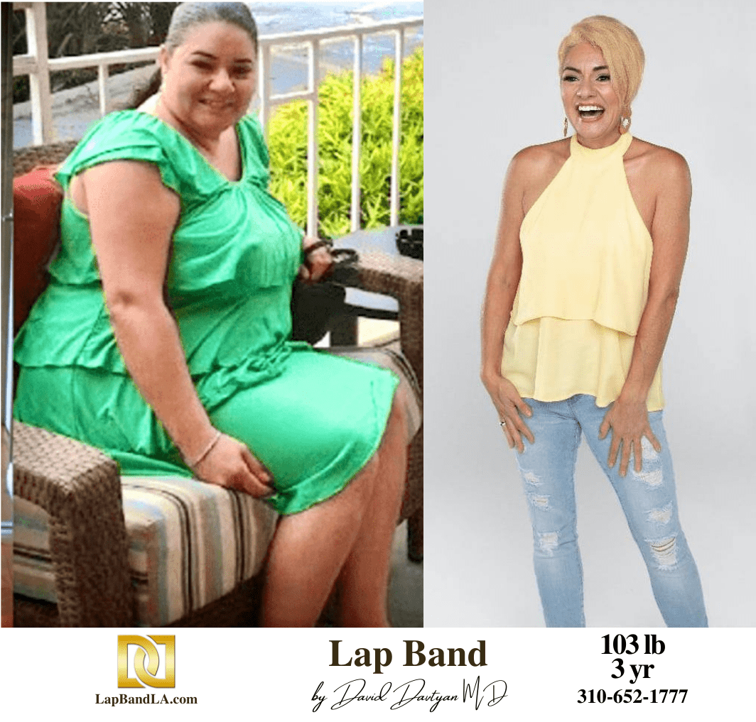 Dr Davtyan's female patient before and 3 years after lap band weight loss surgery