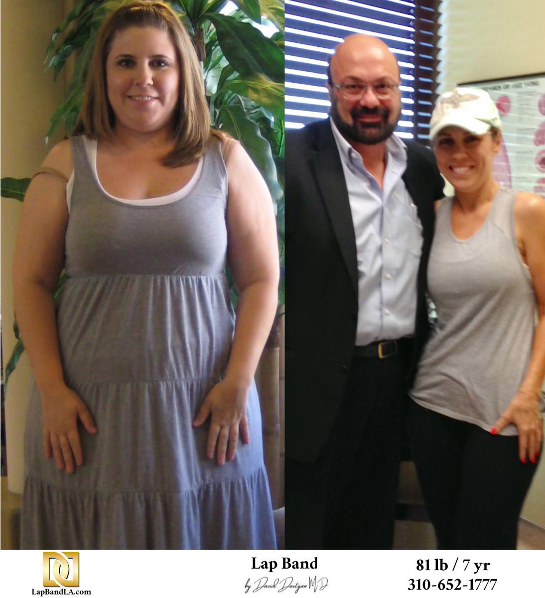 Dr Davtyan's female patient before and 7 years after lap band weight loss surgery
