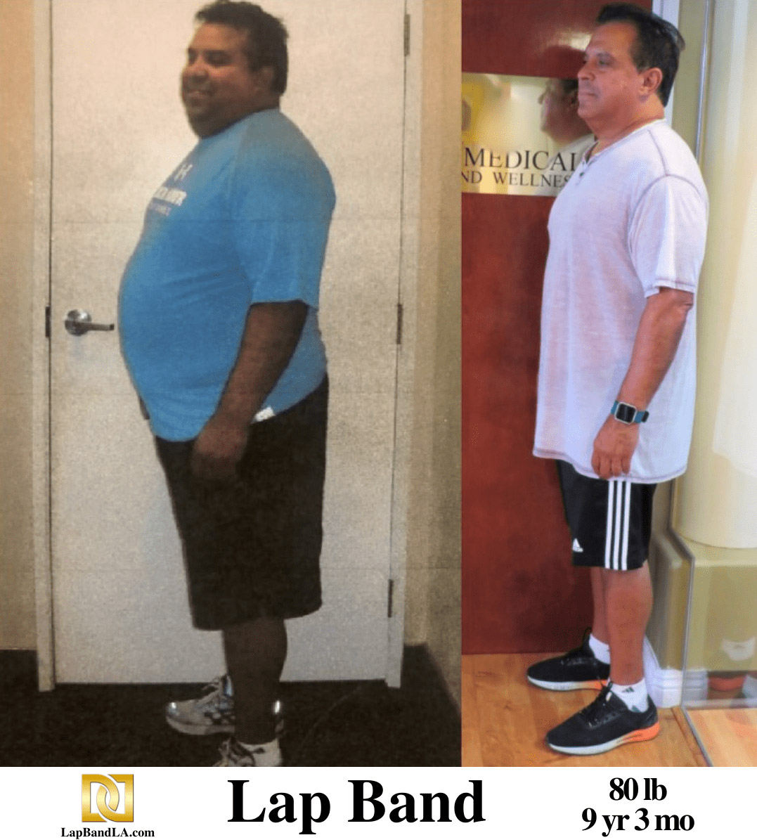 Dr Davtyan's Male Patient Before and After Bariatric Weight Loss Surgery