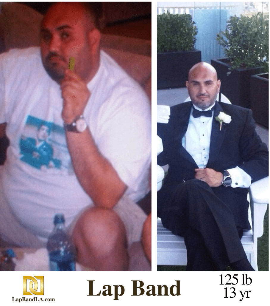 Dr Davtyan's Male Patient, Kashi, Before and After Bariatric Weight Loss Surgery