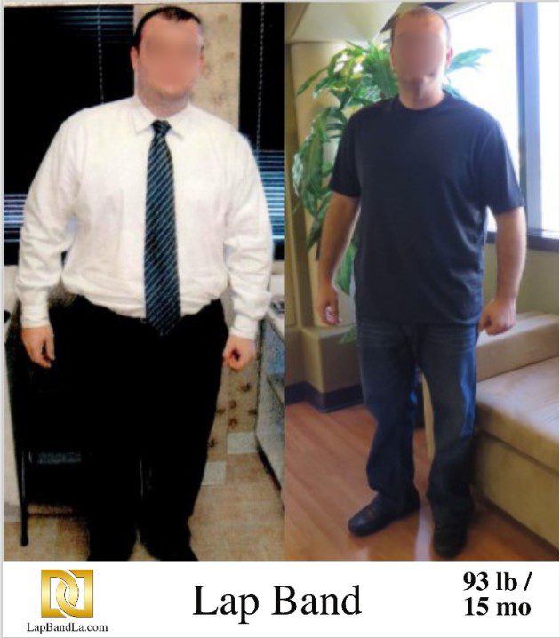 Dr Davtyan's Male Patient Before and After Bariatric Weight Loss Surgery
